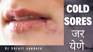 Cold Sores  जर येणे  Ayurvedic Home cure  घरगुति उपाय [upl. by Bohner894]