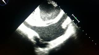 Echocardiogram  thrombus in the left atrium [upl. by Anirok859]