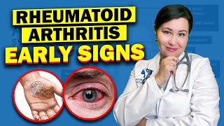 Early Warning Signs Of Rheumatoid Arthritis  Dont Ignore These Vital Symptoms [upl. by Malda]