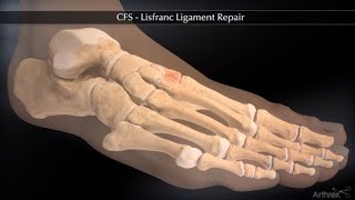 CFS Lisfranc Ligament Repair [upl. by Zrike]