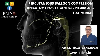 BALLOON COMPRESSION RHIZOTOMY trigeminal neuralgia treatment [upl. by Limemann]