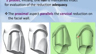 5 Metal Ceramic Crown Preparation StepbyStep بالعربي [upl. by Atiuqihc]