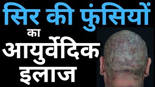 Ayurvedic Treatment for Scalp Folliculitis Causes amp Home Remedies [upl. by An]