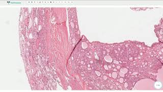 Follicular Adenoma  Thyroid Gland Histopathology [upl. by Solrac]