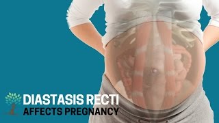 How Diastasis Recti Affects Pregnancy  Diastasis Ed 5 [upl. by Idnahc]