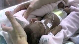 NICU and ECMO Care for Newborns with Congenital Diaphragmatic Hernia CDH 5 of 11 [upl. by Annagroeg]