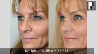 Rhinoplasty Review amp Testimonial by Dr Julian De Silva [upl. by Crissie]