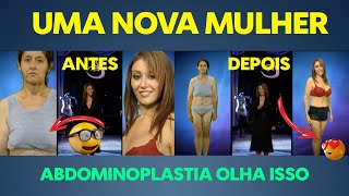 ABDOMINOPLASTIA ANTES E DEPOIS REACT [upl. by Nelra]