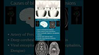 Bilateral thalamic lesions  Cause  Radiology [upl. by Rankin]