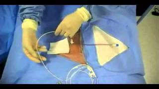 Insertion of Transvenous Pacemaker [upl. by Sage]