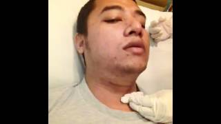 Thyroglossal cyst duct operation [upl. by Ecydnarb]