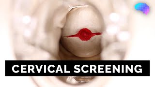 Cervical Screening SMEAR  OSCE Guide  UKMLA  CPSA [upl. by Alanson]