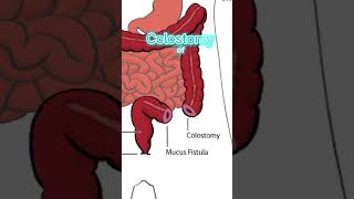 COLOSTOMY  MEDICAL DEFINITION  Medical Consecutive Interpreting [upl. by Stedt]