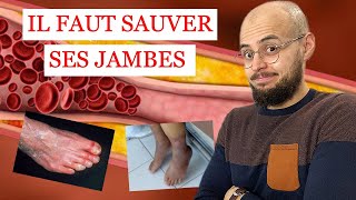 ARTÈRES des jambes BOUCHÉES et ULCÈRE de la PEAU ce quil faut savoir [upl. by Byrdie386]