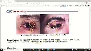 eyelids diseases [upl. by Lerad]