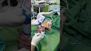 Newborn intubation using UE Miller 0 blade [upl. by Daffie782]