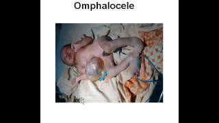 birth defect  omphalocele amp gastroschisis [upl. by Yoshi]