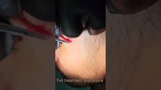 LIPOMA TREATMENT quotRemoving a Facial Lipoma StepbyStep Procedure 9583357766 [upl. by Gaiser817]