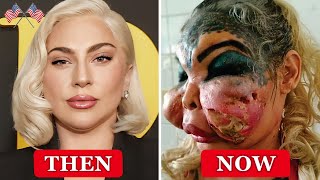 Lady Gaga And 10 Stars Shocked By Failed Plastic Surgery  Then And Now 2024 [upl. by Trabue]