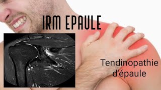 IRM DE L’EPAULE  tendinopathie [upl. by Kelwen]