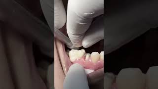 Zirconia crowns dentist [upl. by Jorry]