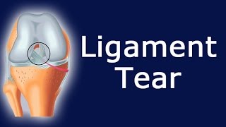 Ligament Tear [upl. by Whiteley]