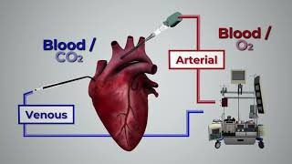 Circulación Extracorpórea ECMO [upl. by Maddie647]