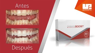 Conozca el blanqueamiento dental en consultorio Opalescence Boost [upl. by Suiratnauq596]