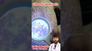 Skin Disease Psoriasis Treatment  Biological injection of Psoriasis psoriasis skincare skin [upl. by Eeleak]