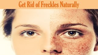 How to Get Rid of Freckles Naturally and Fast Overnight Permanently [upl. by Nashom588]