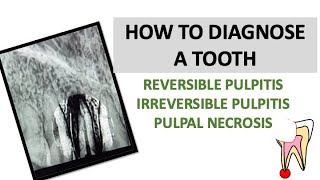 HOW TO DIAGNOSE A TOOTH REVERSIBLE AND IRREVERSIBLE PULPITIS  PULPAL NECROSIS  dentalcafe4331 [upl. by Jacinta938]