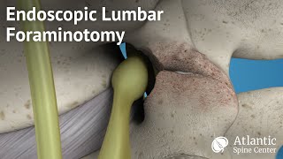 Endoscopic Lumbar Foraminotomy [upl. by Solraced]