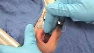 IntubationHow to perform endotracheal intubation  2 [upl. by Anelhtak]