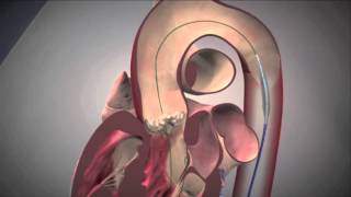 Edwards SAPIEN Transcatheter Aortic Valve Replacement [upl. by Ntsuj]