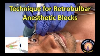 Technique for Retrobulbar Anesthetic Injection for Eye Surgery [upl. by Horsey492]