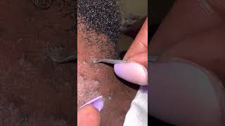 So many ingrown hairs [upl. by Ennaoj]