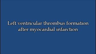 Left ventricular thrombus after myocardial infarction [upl. by Nalani]