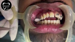 CLASS 2 DIV 1  BRACES  ORTHODONTICS  ANANTNAG trending braces dentist imrankhan [upl. by Llenrahc759]