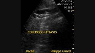 Vscan Coledocolitiasis con barro biliar [upl. by Haveman]