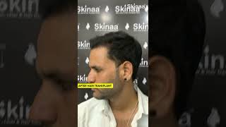 From Hair Loss to Hair Confidence Incredible Hair Transplant Results at Skinaa viral shorts [upl. by Itteb]