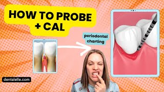 Are You Doing It Wrong Detailed Perio Charting and Cal  Recession  Inflammation [upl. by Dareg535]