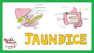 JAUNDICE Differential diagnosis of Jaundice  PrehepaticHepaticPost Hepatic Causes of Jaundice [upl. by Aierb]