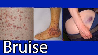 Bruise Hematoma blue spots on skin causes and treatment [upl. by Attey262]