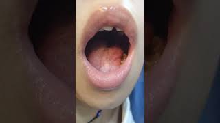 tongue wasting amp fasciculation [upl. by Attayek]