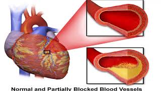 What Is Coronary Artery Disease [upl. by Bethezel324]