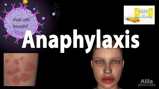 Anaphylaxis Animation [upl. by Nwadrebma]