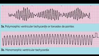 TORSADES DE POINTES 4TH YR [upl. by Trisa]