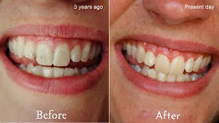 DIY Remineralising Toothpaste  Restore tooth enamel naturally [upl. by Hazel]