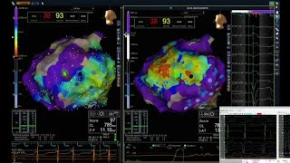 Sistema per migliorare terapia ablativa delle aritmie cardiache [upl. by Eirffej]