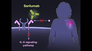 Sarilumab for Relapse of Polymyalgia Rheumatica  NEJM [upl. by Einahteb]